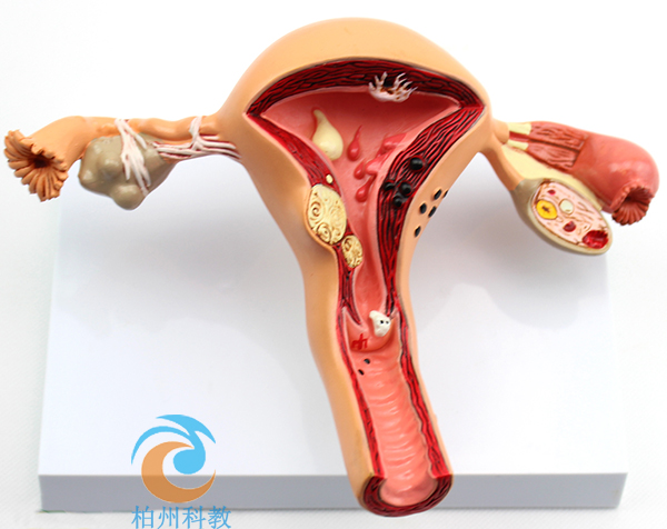 子宫、卵巢病理模型