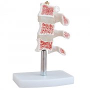 骨质疏松模型(脊椎典型病变模型)