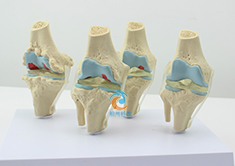 4阶段膝关节模型